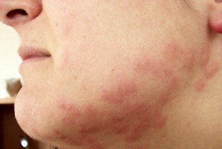 bed bug bites characteristics of bed bug bites