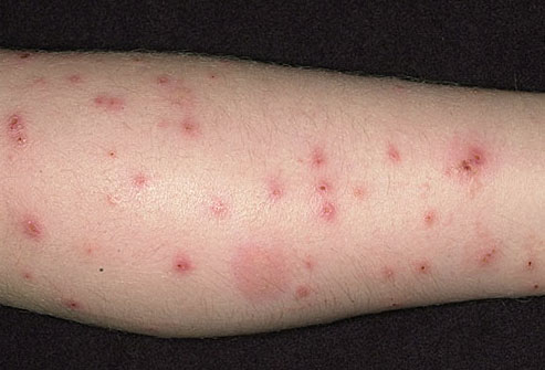 Flea Bites Vs Bed Bug Bites On Humans Flea bites