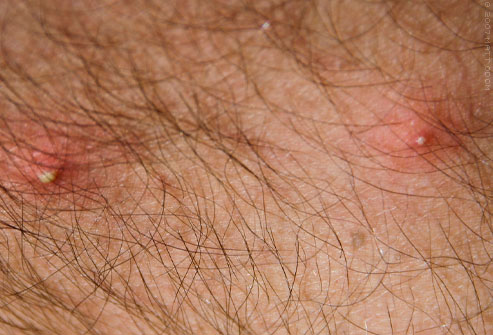 Insect Bites Identifications | MD-Health.com