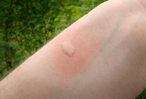 Insect Bites Identifications | MD-Health.com