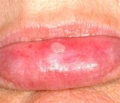 Cheilitis - Wikipedia