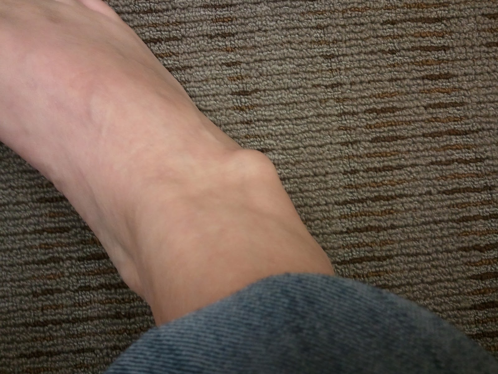 Why Do You Have Lump on Your Ankle? | MD-Health.com