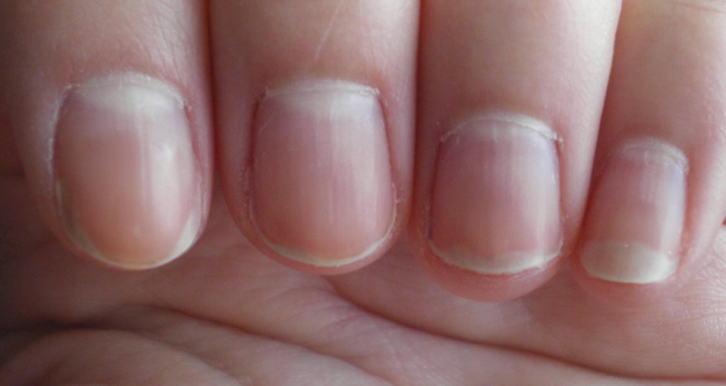 nail bed color and anemia