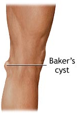 cyst baker bakers knee popliteal symptoms causes leg pain swollen treatment md health treatments vein