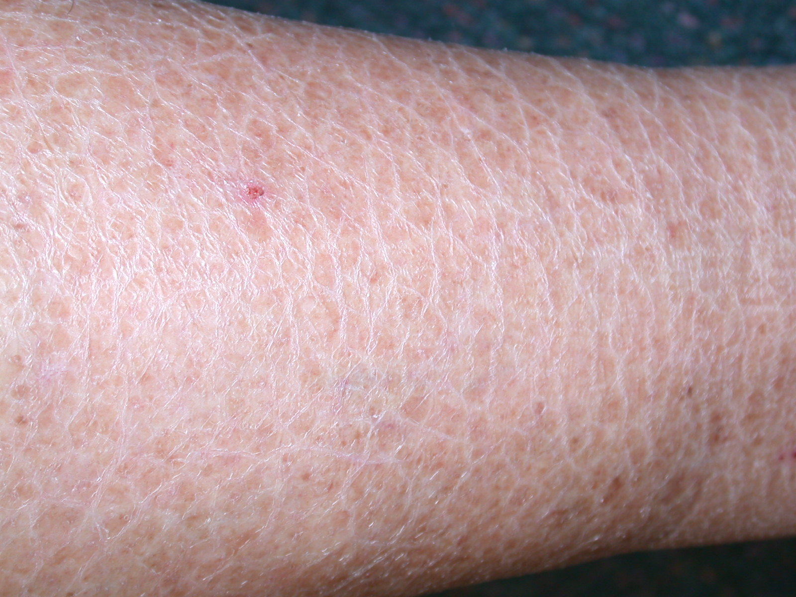 Scaly Skin Patches - Diseases Pictures