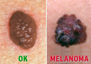 Who determines a spot is skin cancer?