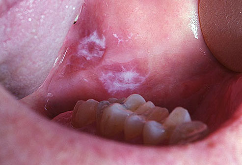 Mouth Cancer Syptoms