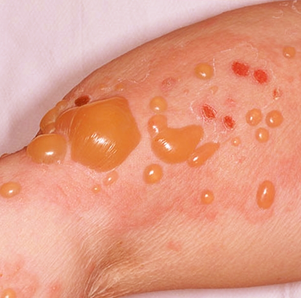 bullous pemphigoid pictures