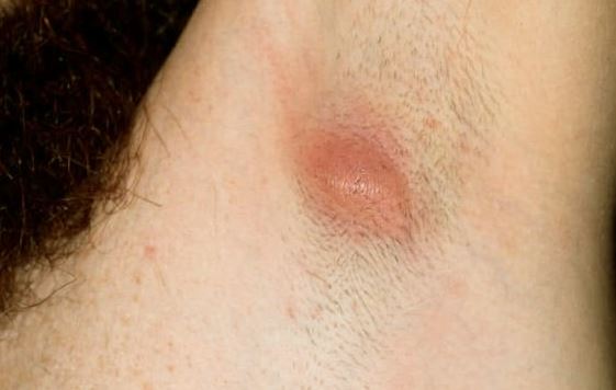 Why Are Your Sweat Glands Under Armpit Blocked Md