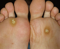 wart on bottom of feet #10