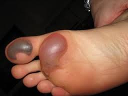 What causes blisters on the skin? - WebMD Boots