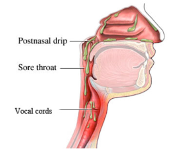 What can I do to clear up mucus in my throat?