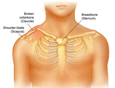 Clavicle Collarbone Pain Causes And Treatments MD Health