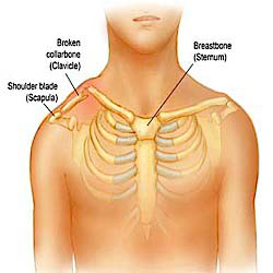 Clavicle Fracture Symptoms and Treatments | MD-Health.com