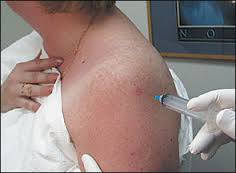 Steroid injection marks