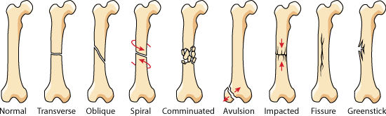 What is a nondisplaced fracture?