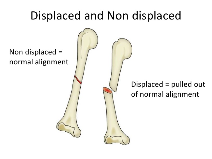 What is a nondisplaced fracture?