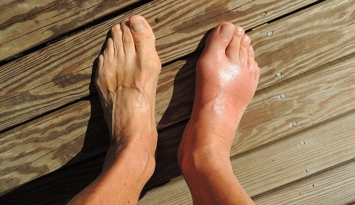 Swelling On Top Of Feet 55