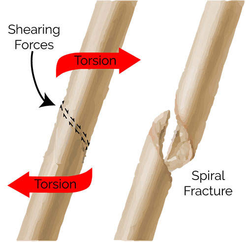 Spiral Fracture of Humerus: Signs, Treatments & Prevention | MD-Health.com