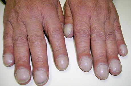 Is Black Streaks In Your Fingernails A Cause For Concern Md Clubbed Nails Occur When The Toes Or Fingertips Have Widened And Seem To Bulge Past Your Last Knuckle Curved Down As If They