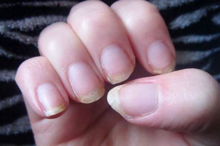 Is Black Streaks in Your Fingernails a Cause for Concern ...