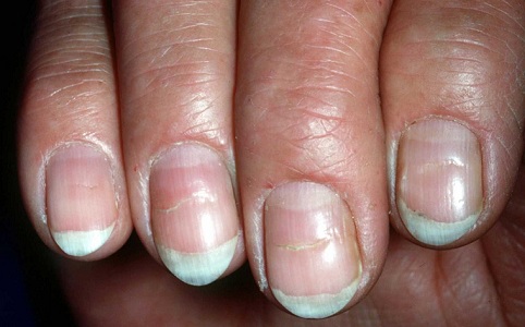 Is Black Streaks In Your Fingernails A Cause For Concern Md White Ridges Across The Nail Beds