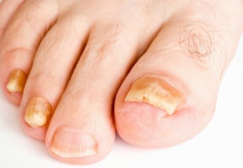What to Do When Your Toenail Thickens | MD-Health.com