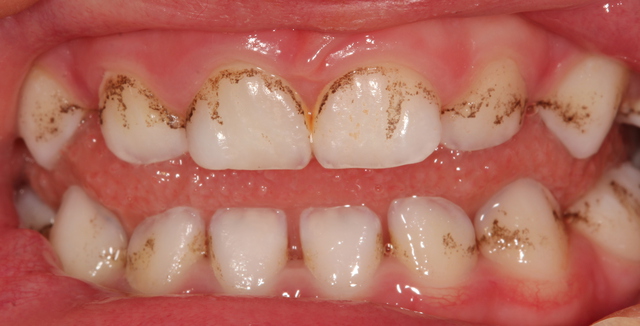Black Stains on the Teeth: Major Causes and Best Solutions | New Health