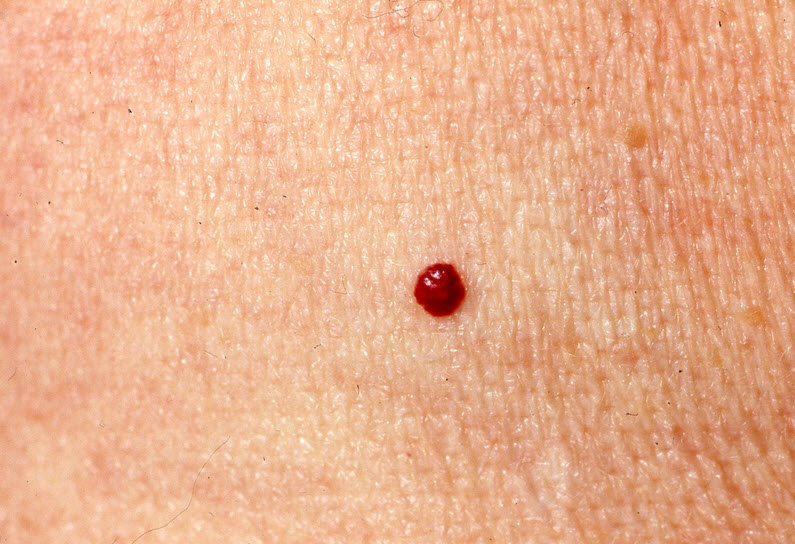 Cherry Angioma Symptoms，causes And Treatments Md 