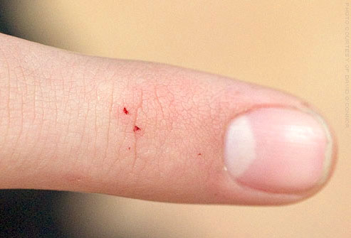 How to Identify Insect Bites and Treat Them | MD-Health.com
