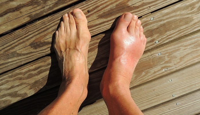 swollen top of foot causes