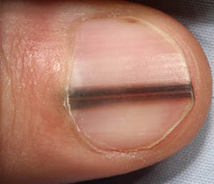 Is Black Streaks in Your Fingernails a Cause for Concern 