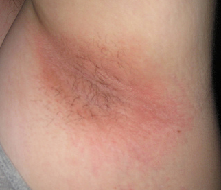 What Causes Itchy Underarms - Check spelling or type a new query.