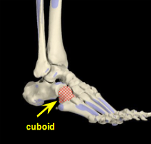 cuboid fracture foot bone stress pain treatment md health diagnosis cause causes where symptoms