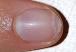 Why Are My Nails Peeling and What to Do? | New Health Advisor