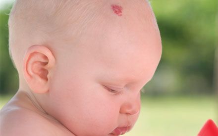 Birthmarks Types and Other Things You Should Know | New Health Advisor